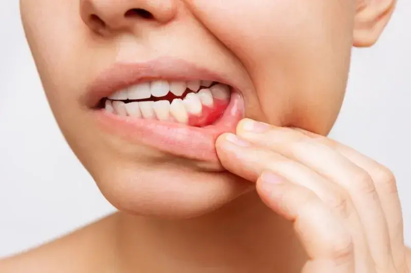 Bleeding Gums Treatment in Kothrud