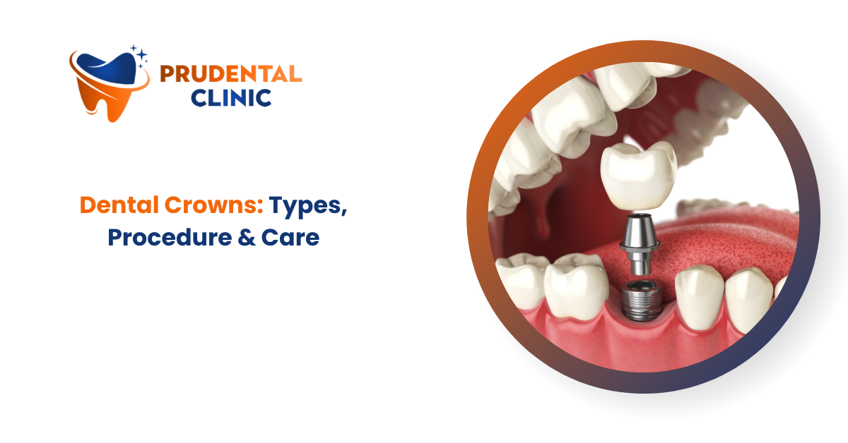 Dental Crowns: Types, Procedure & Care