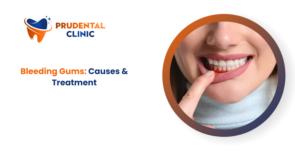 Bleeding Gums: Causes & Treatment