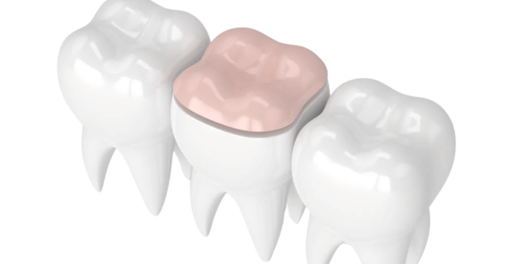 Composite Fillings