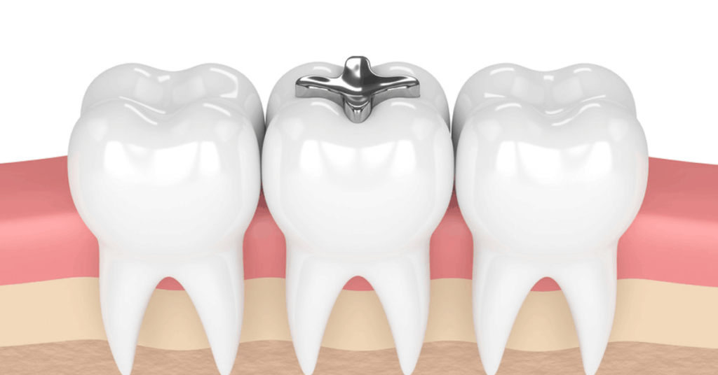 Amalgam Fillings